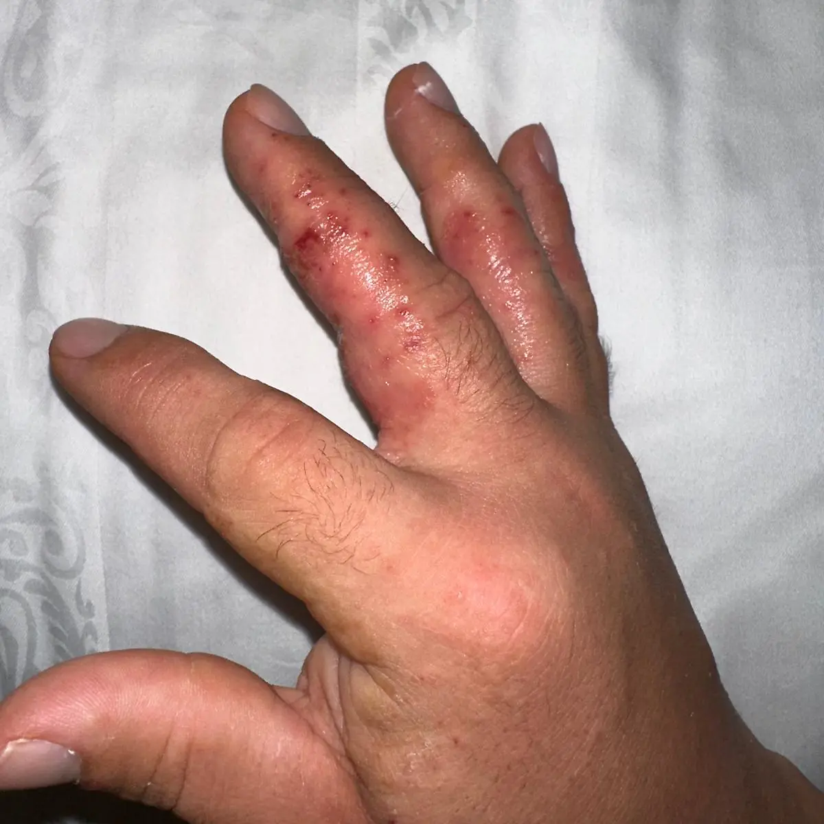 Kappel Hand
